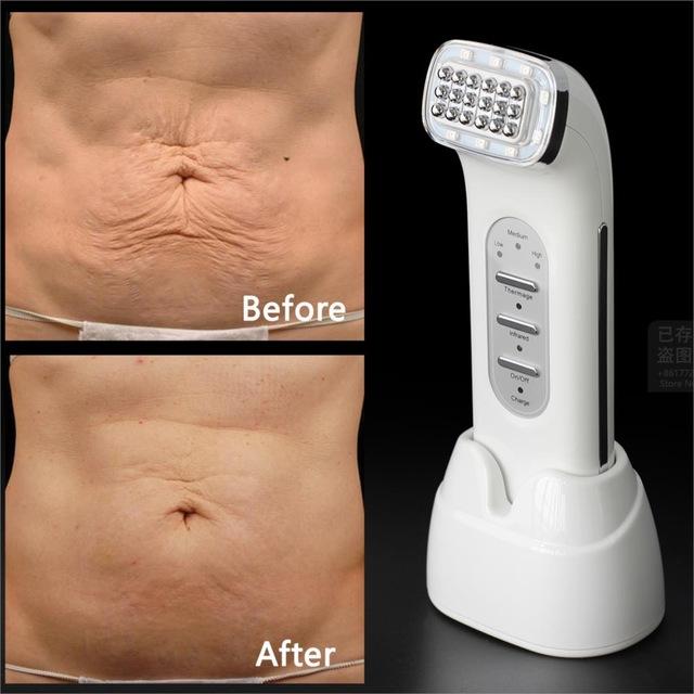 Dot Matrix RF Skin Lifting Wrinkle Removal Facial Beauty Machine