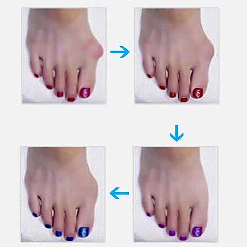 1 Pair Bunion Splint Big Toe Corrector Hallux Valgus Straightener