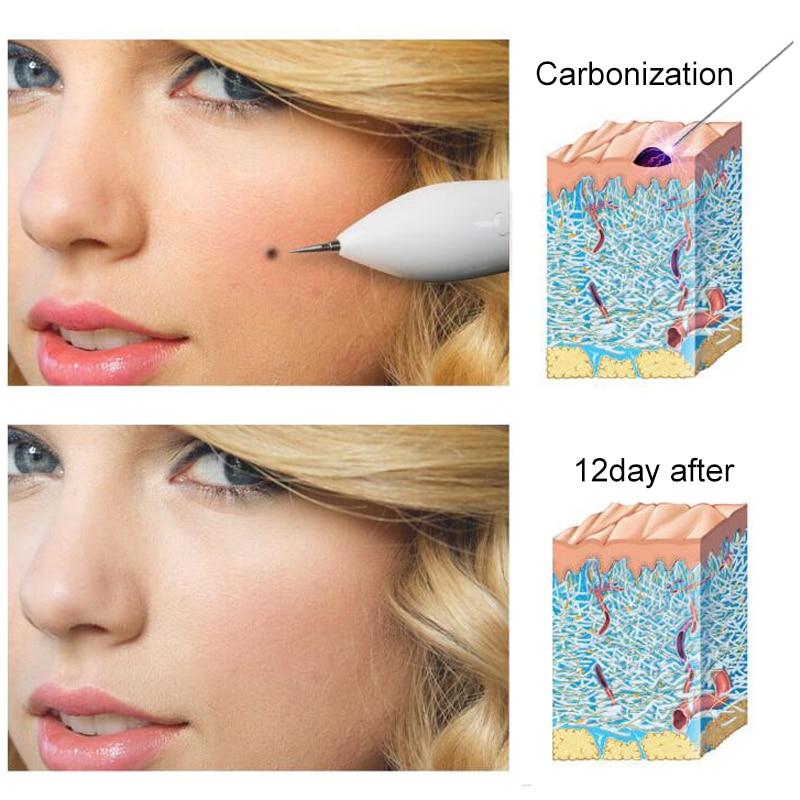 Laser Mole Freckle Dark Spot Remove Tool Tag Wart Plasma Pen