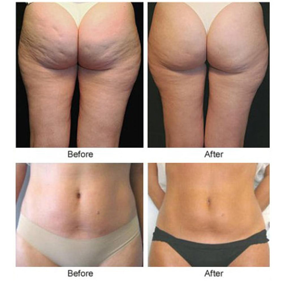 5 pcs Neutriherbs Body Applicator Skin Tightening Firming Cream