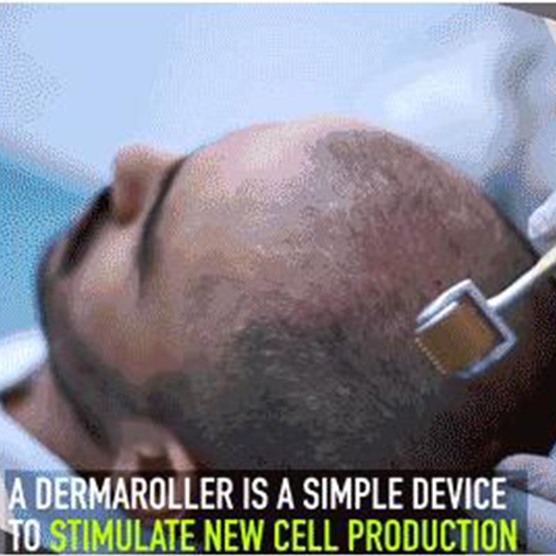 0.25-2.0mm 540 Titanium Hair Care Derma Micro-needling Roller