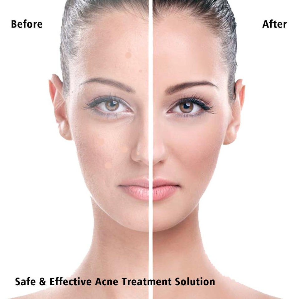 36 Pcs Acne Pimple Removal Patch Anti-inflammatory Smoothing Treatment Sticker