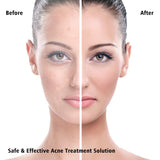 36 Pcs Acne Pimple Removal Patch Anti-inflammatory Smoothing Treatment Sticker